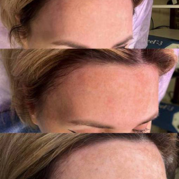 Петрушковий пілінг
                    Косметологічний центр  Ужгород