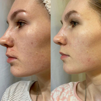 Гліколевий пілінг
                    Косметологічний центр  Ужгород