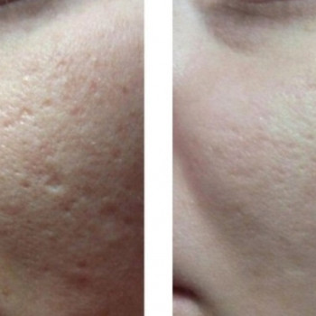 ТСА пілінг
                    Косметологічний центр  Ужгород