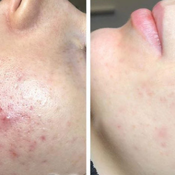 Ензимний пілінг
                    Косметологический центр  Ужгород