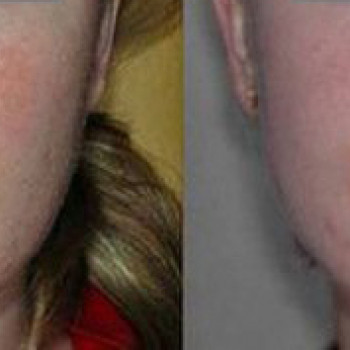 ABR пілінг
                    Косметологический центр  Ужгород