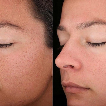 Гранатовий пілінг
                    Косметологический центр  Ужгород