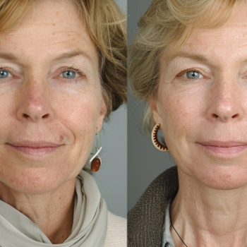 Програма для сухої шкіри
                    Косметологический центр  Ужгород