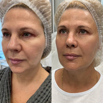 Мезотерапія обличчя/тіла
                    Косметологічний центр  Ужгород