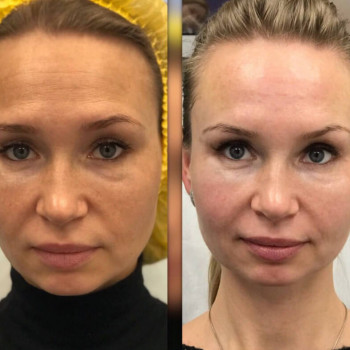 Мезотерапія обличчя/тіла
                    Косметологічний центр  Ужгород