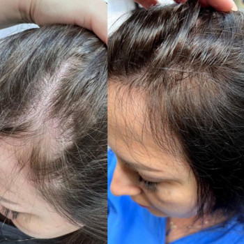 Мезотерапія волосся
                    Косметологический центр  Ужгород