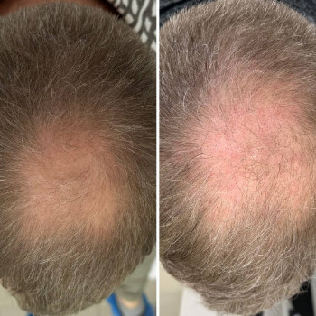 Мезотерапія волосся
                    Косметологический центр  Ужгород