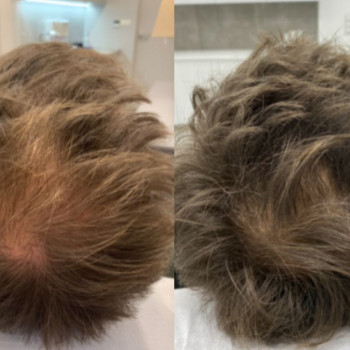 Мезотерапія волосся
                    Косметологический центр  Ужгород