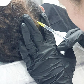 Мезотерапія волосся
                    Косметологический центр  Ужгород