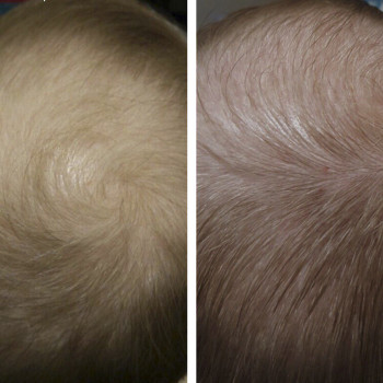 Мезотерапія волосся
                    Косметологический центр  Ужгород