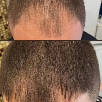 Мезотерапія волосся
                    Косметологический центр  Ужгород