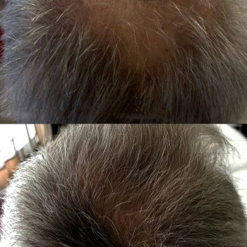 Мезотерапія волосся
                    Косметологический центр  Ужгород