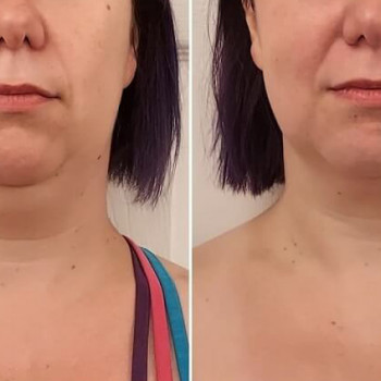 Ліполітики непрямі
                    Косметологический центр  Ужгород