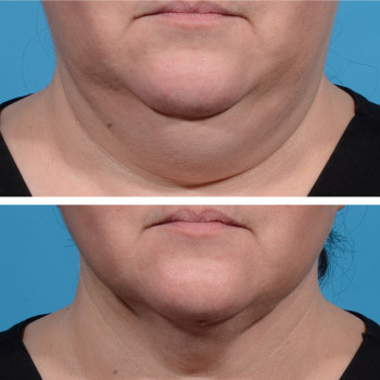 Ліполітики непрямі
                    Косметологический центр  Ужгород