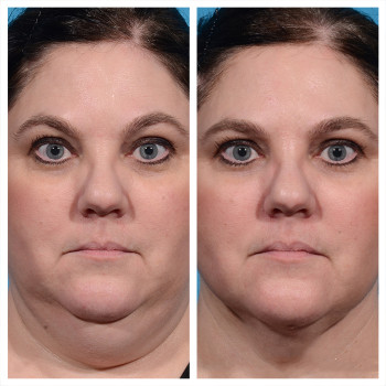 Ліполітики непрямі
                    Косметологический центр  Ужгород