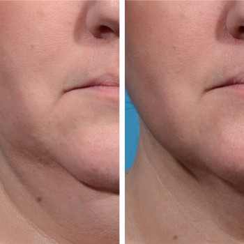 Ліполітики непрямі
                    Косметологический центр  Ужгород