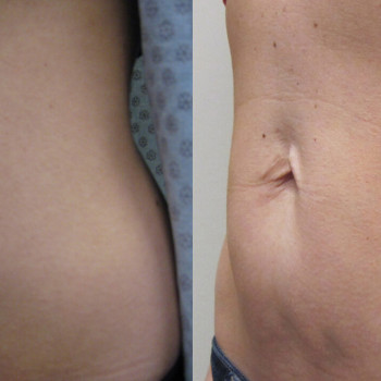 Ліполітики прямі
                    Косметологічний центр  Ужгород