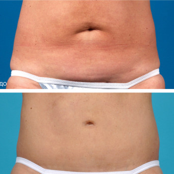 Ліполітики прямі
                    Косметологічний центр  Ужгород