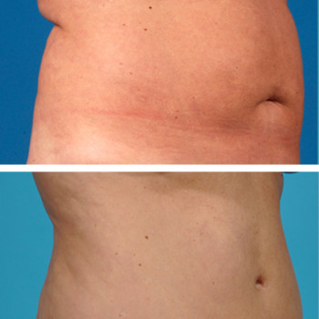 Ліполітики прямі
                    Косметологічний центр  Ужгород