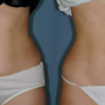 Ліполітики прямі
                    Косметологічний центр  Ужгород