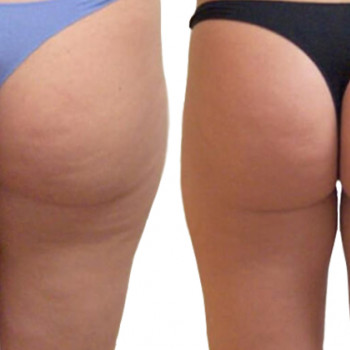 Ліполітики прямі
                    Косметологічний центр  Ужгород