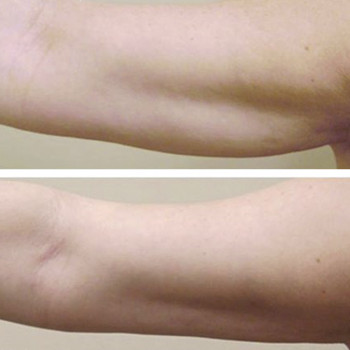 Ліполітики прямі
                    Косметологічний центр  Ужгород