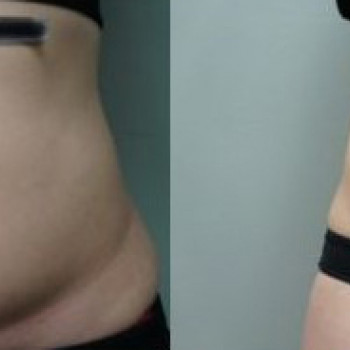 Ліполітики прямі
                    Косметологічний центр  Ужгород