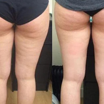 Ліполітики прямі
                    Косметологічний центр  Ужгород