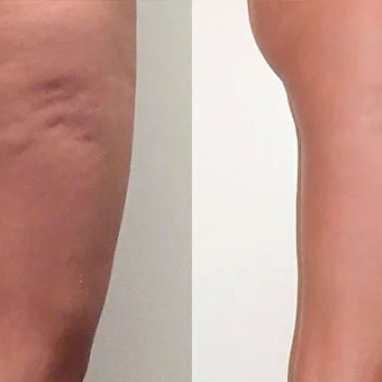 Ліполітики прямі
                    Косметологічний центр  Ужгород