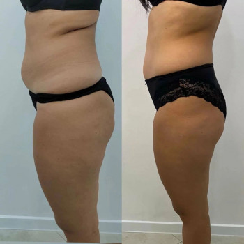 Ліполітики прямі
                    Косметологічний центр  Ужгород