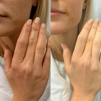 Біоревіталізація тіла
                    Косметологічний центр  Ужгород