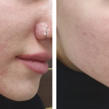 Acneout мезотерапія
                    Косметологический центр  Ужгород