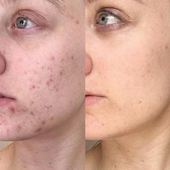 Acneout мезотерапія
                    Косметологический центр  Ужгород