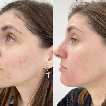 Acneout мезотерапія
                    Косметологический центр  Ужгород