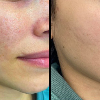 Acneout мезотерапія
                    Косметологический центр  Ужгород