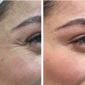 Аргірелін мезотерапія
                    Косметологический центр  Ужгород