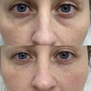 Eyebag мезотерапія
                    Косметологический центр  Ужгород