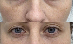Eyebag мезотерапія Косметологічний центр  Ужгород