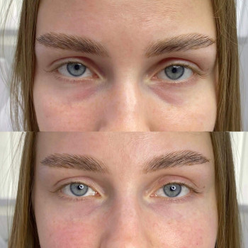 Eyebag мезотерапія
                    Косметологический центр  Ужгород