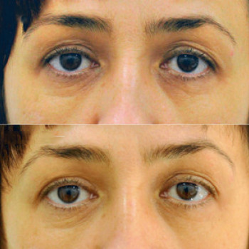 Eyebag мезотерапія
                    Косметологический центр  Ужгород