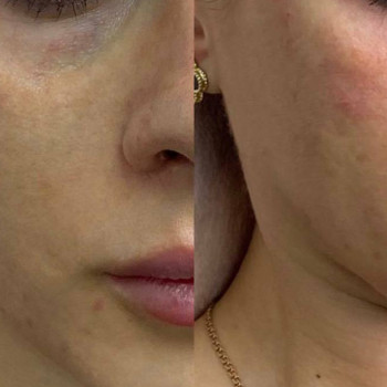 Eyebag мезотерапія
                    Косметологический центр  Ужгород