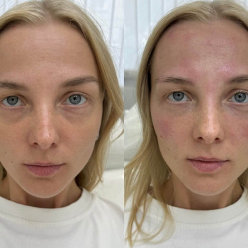 Eyebag мезотерапія
                    Косметологический центр  Ужгород