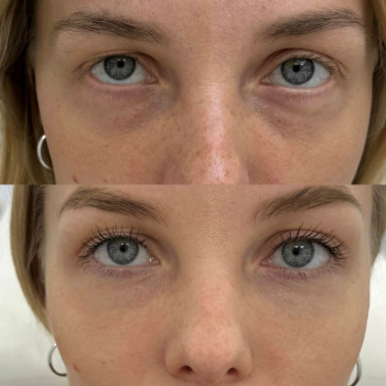Eyebag мезотерапія
                    Косметологический центр  Ужгород