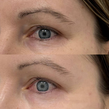 Eyebag мезотерапія
                    Косметологический центр  Ужгород