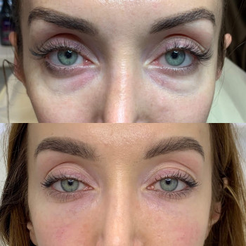 Eyebag мезотерапія
                    Косметологический центр  Ужгород