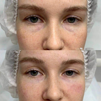 Eyebag мезотерапія
                    Косметологический центр  Ужгород