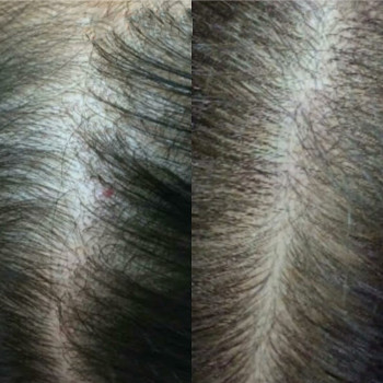 Біотин мезотерапія
                    Косметологический центр  Ужгород