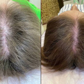 Біотин мезотерапія
                    Косметологический центр  Ужгород