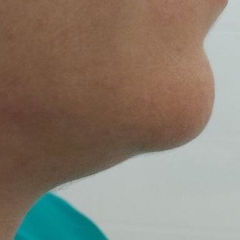 Мелілото мезотерапія
                    Косметологический центр  Ужгород