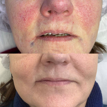 Лаенек (Laennec) терапія
                    Косметологічний центр  Ужгород